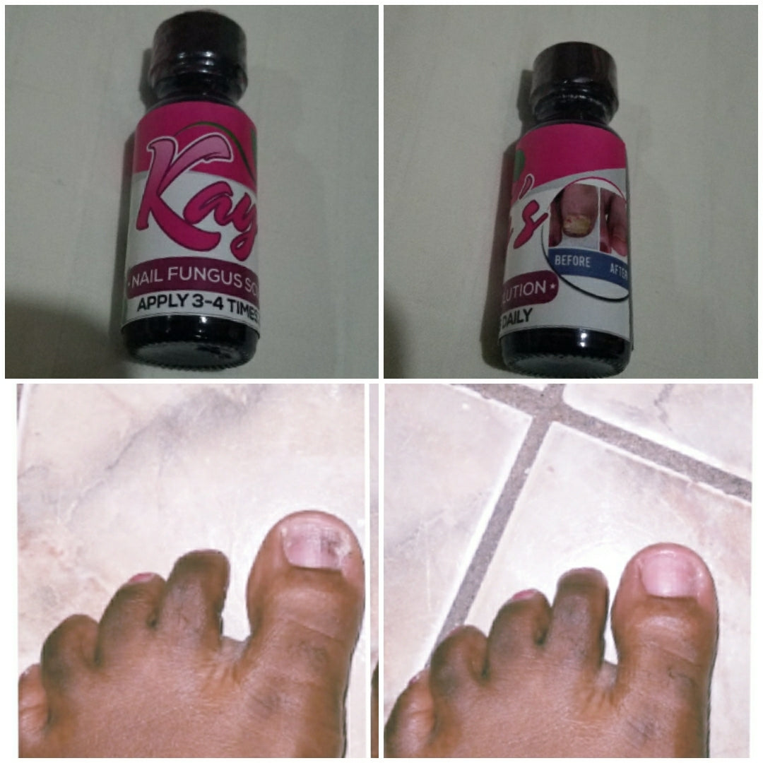 Nail Fungus Treatment